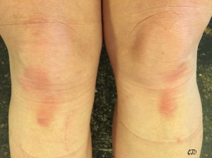 Butt-ass fugly knees complete with scars, bruises and knee pad marks.